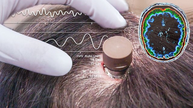 Người đ&#224;n &#244;ng bị liệt chỉnh sửa video, đăng YouTube &#39;chỉ bằng suy nghĩ&#39;: Ca cấy chip n&#227;o Neuralink thứ ba g&#226;y chấn động - Ảnh 1